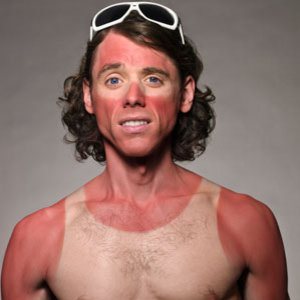 sunburn-man