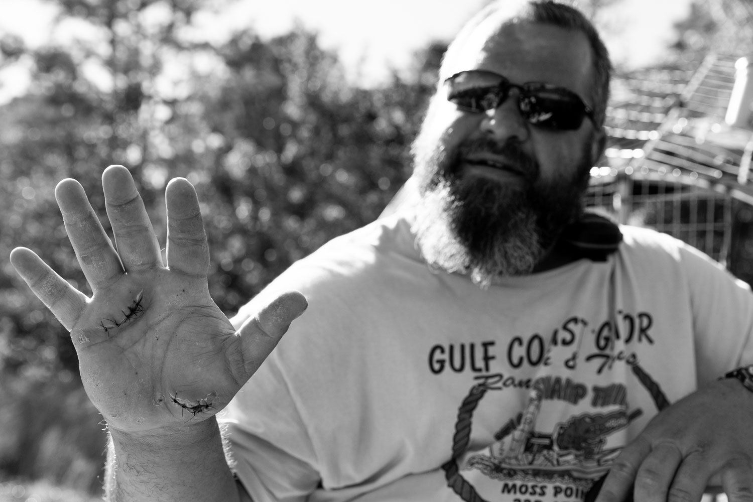Black and white photo of a bearded man with sunglasses holding up the palm of his right hand to the camera to show two sets of black stitches in the shape and pattern of an alligator bite.